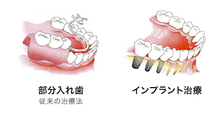 インプラントと入れ歯の違い