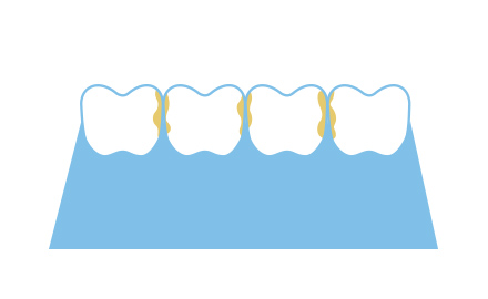 歯と歯の間のイメージ