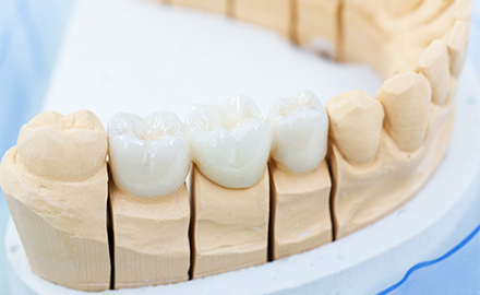 詰め物・かぶせ物の歯科材料イメージ