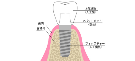 インプラントイメージ